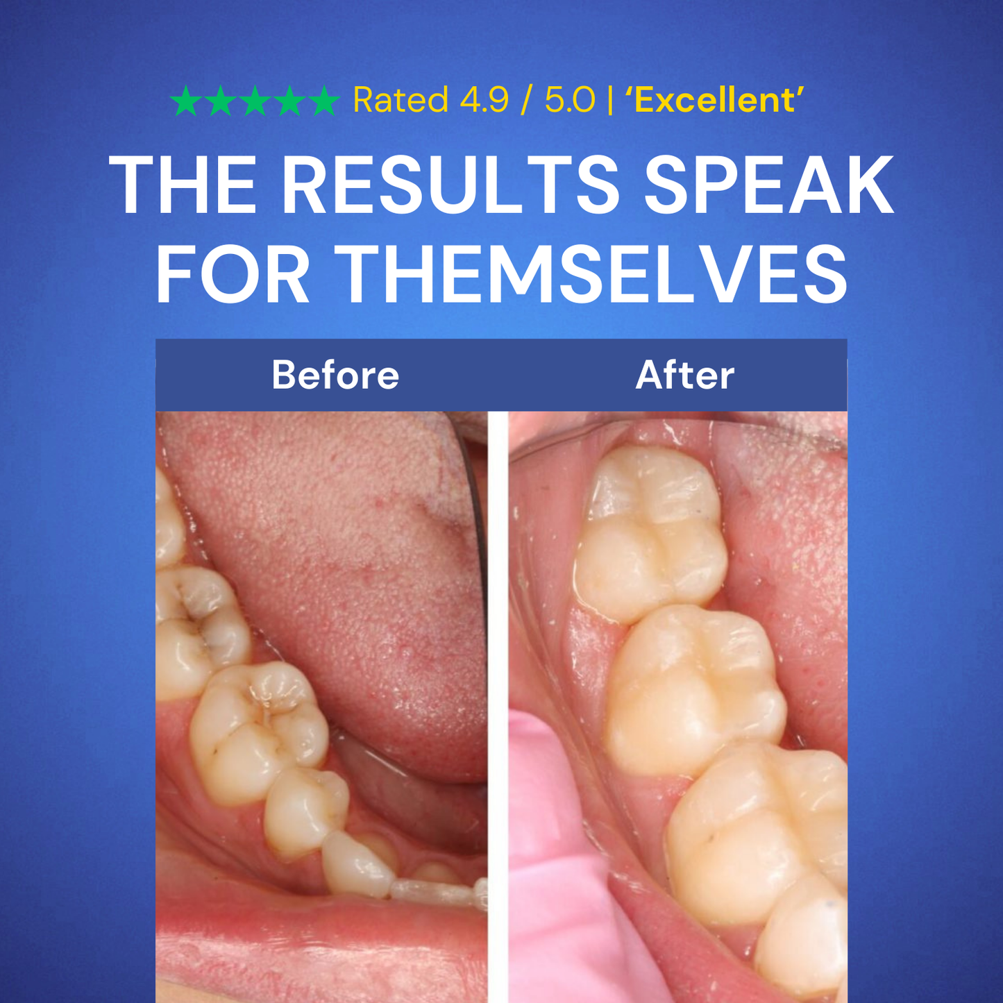 Dentite™ Tooth Armor