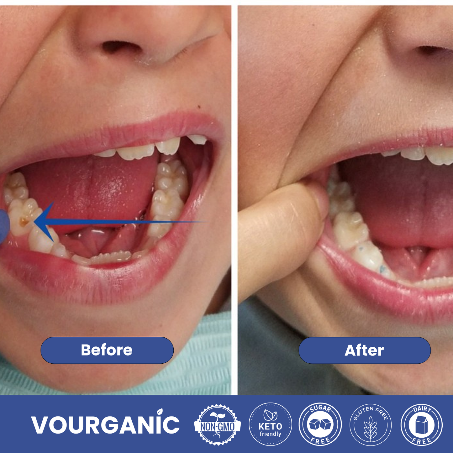 Dentite™ Tooth Armor